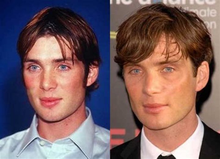 Cillian Murphy Nose | Did He Underwent Surgery | Before And After Pics